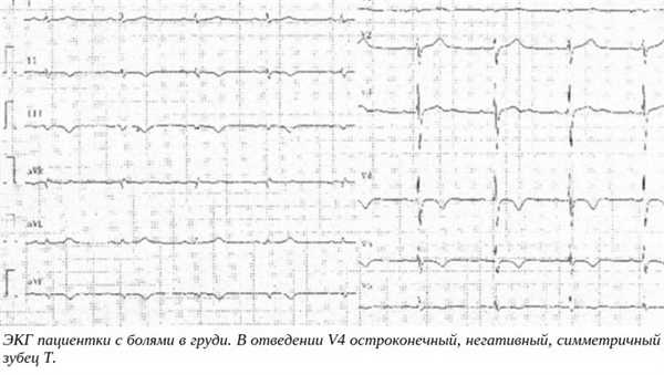 ЭКГ пациентки с болями в груди. В отведении V4 остроконечный, негативный, симметричный зубец T.