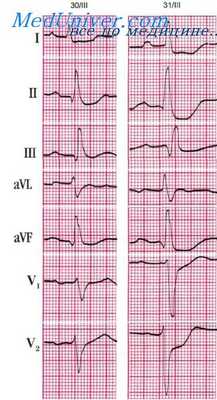 циркулярный инфаркт миокарда