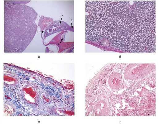 Парагонимоз