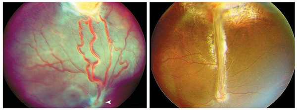 Аномалии сетчатки глаза