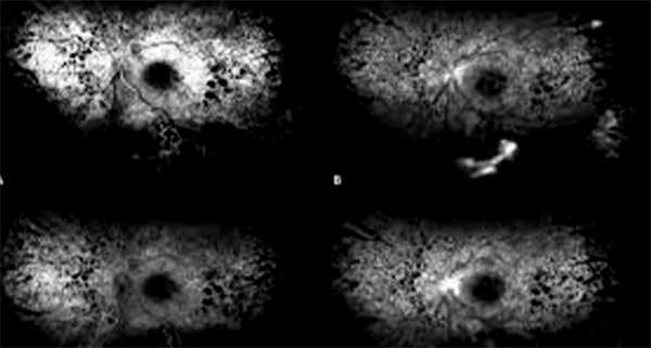 Диагностика ретинита Коатса