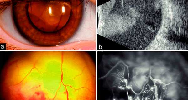 Болезнь Коатса