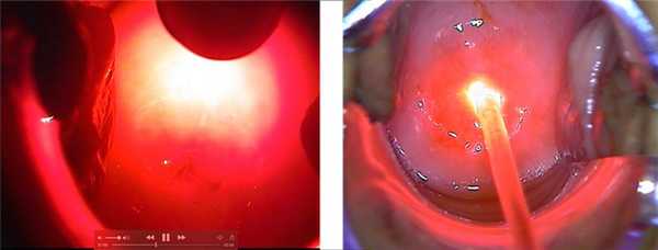 фотодинамическая терапия