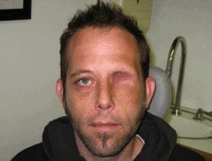 Экзентерация