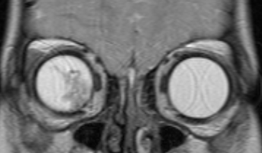 Визуализация ретинобластомы с помощью МРТ. Фронтальное изображение орбит. Клиническая группа D