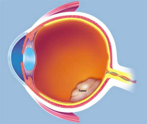 Ретинобластома