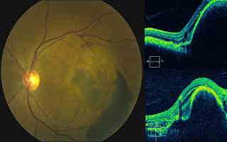 Отслойка пигментного эпителия