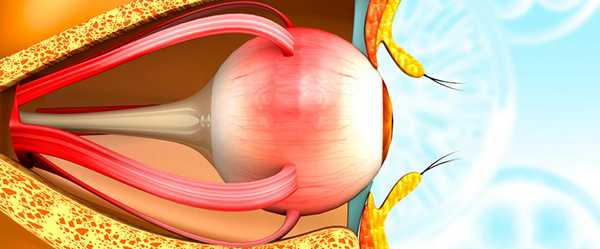 Болезнь Гиппеля-Линдау: гемангиобластома сетчатки