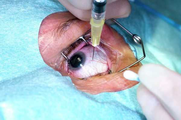 Лечение влажной макулодистрофии