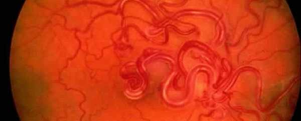 Аномалии сетчатки