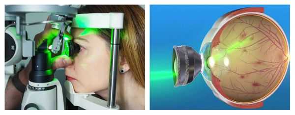 Отграничительная лазерная коагуляция