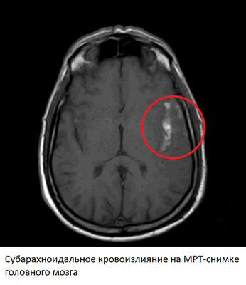 Субарахноидальные кровоизлияния