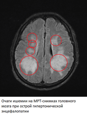 Острая гипертоническая энцефалопатия