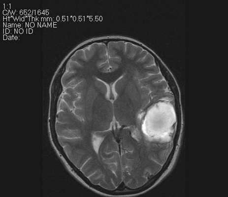Признаки острого нарушения мозгового кровообращения на МРТ