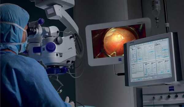 субтотальная витрэктомия