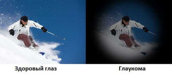 Глаукома - причины развития