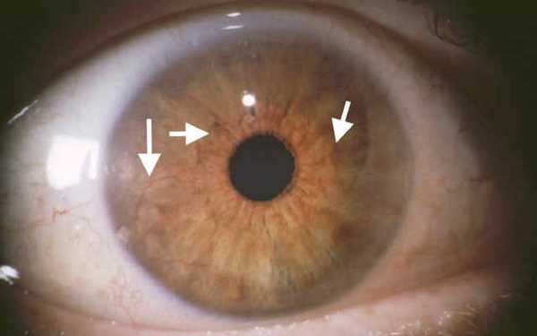 Глаукома - рубеоз радужки