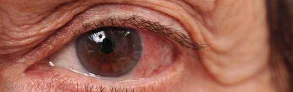 Глаукома - неоваскулярная