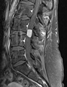 менингиома