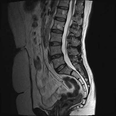 Гемангиомы на снимке МРТ поясницы
