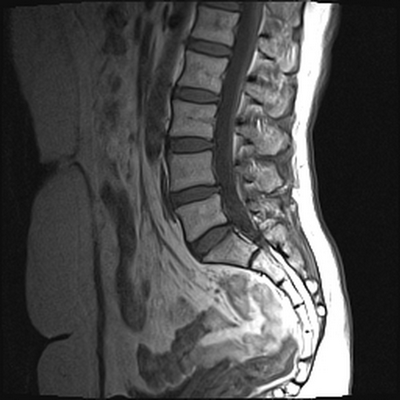 МРТ пояснично-крестцового отдела позвоночника