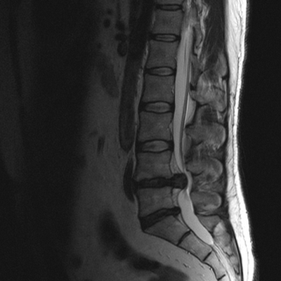 МРТ позвоночного столба