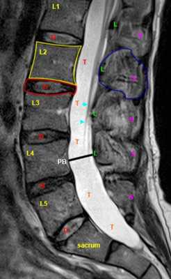sredinnyj-sagittalnyj-srez-t2