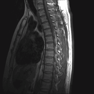 МРТ грудного отдела позвоночника