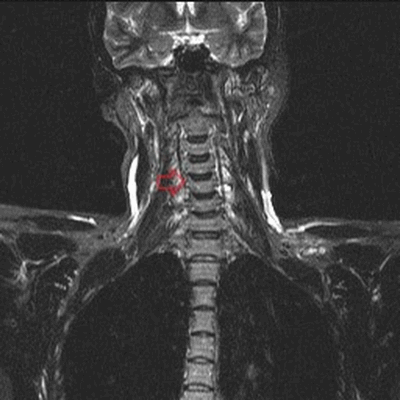 МРТ шейного отдела позвоночника
