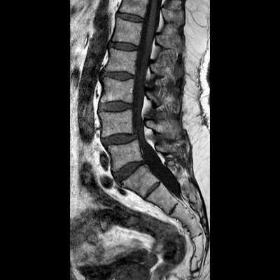 Стеноз позвоночника на МРТ