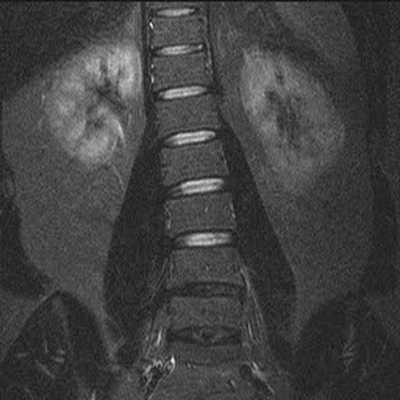 Сколиоз на МРТ