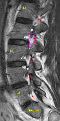 mrt-poyasnicy-mezhpozvonochnye-otverstiya