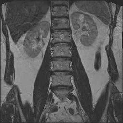 Гемангиомы на снимке МРТ 