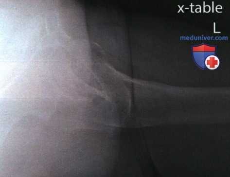 Рентгенограмма тазобедренного сустава в аксиолатеральной проекции (нижневерхней, по методу Данелиуса-Миллера)