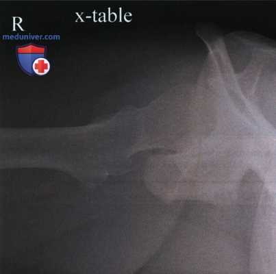 Рентгенограмма тазобедренного сустава в аксиолатеральной проекции (нижневерхней, по методу Данелиуса-Миллера)