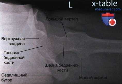 Рентгенограмма тазобедренного сустава в аксиолатеральной проекции (нижневерхней, по методу Данелиуса-Миллера)