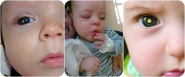 ретинобластома у детей