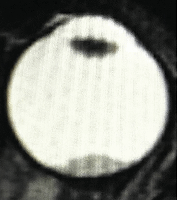 Визуализация ретинобластомы с помощью МРТ. Клиническая группа В