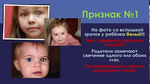 симптомы ретинобластомы