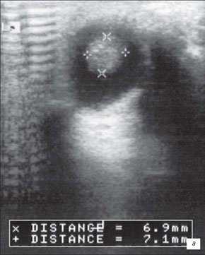 Небольшой ретинобластом
