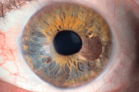 Меланома хориоидеи: реальные опасности болезни