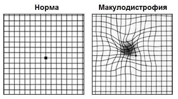 Тест Амслера