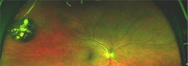 Врождённая гипертрофия пигментного эпителия сетчатки