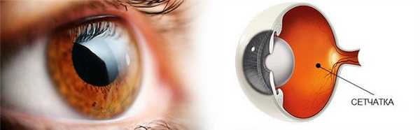 Аномалии развития сетчатки