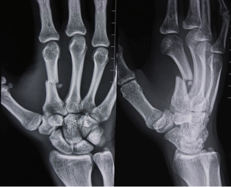 Перелом кисти 5