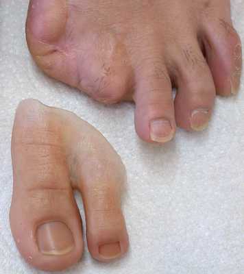 Культя стопы после ампутации пальцев и протез