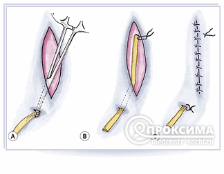 Дренирование послеоперационной раны