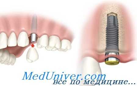 имплантация зубов