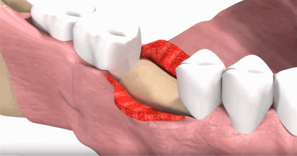 Рассечение десны