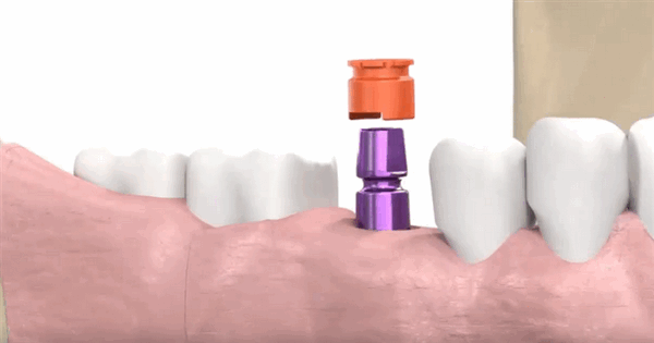 Колпачек на абатмент